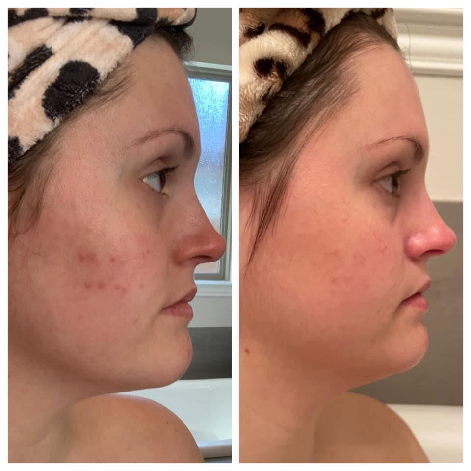 180 Peel (Peel Pads)