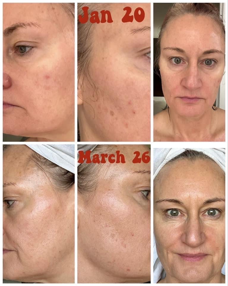 Vitamin C and Collagen Pump (Brightening)