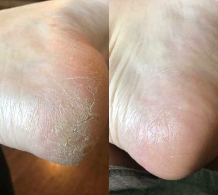 Sole Solution (Pedi in a Bottle)