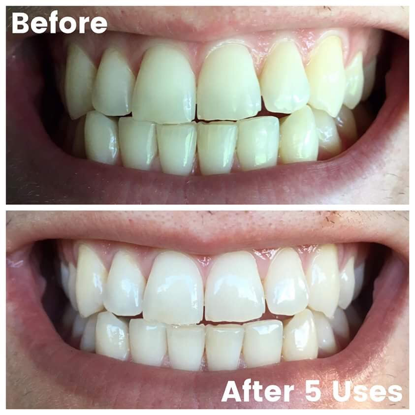 Whitening Toothpaste